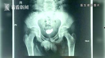 尿道视频,视频解析人体排泄系统的奥秘
