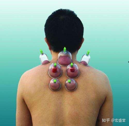 拔罐放血疗法视频,传统中医养生秘技全解析